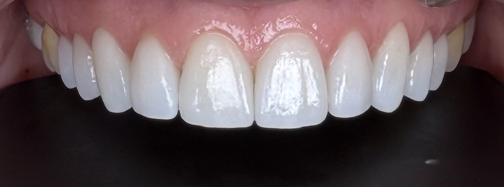 Finished anterior restorative case